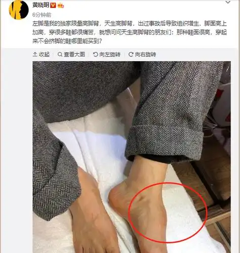 黄晓明天生高脚背在线向网友求助哪里能买到不挤脚的鞋好可怜