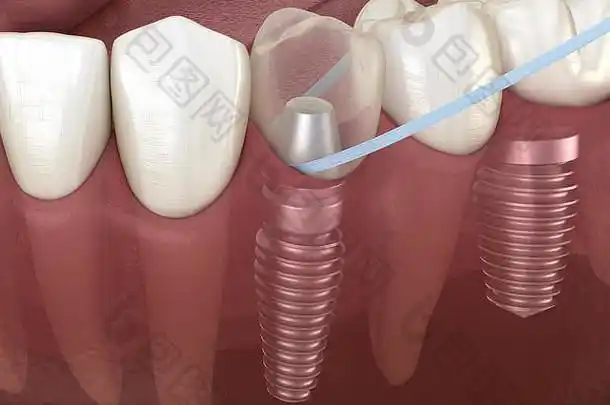种植牙图片-种植牙素材免费下载-包图网