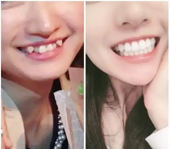 嘿,朋友!你的"虎牙"好看吗?