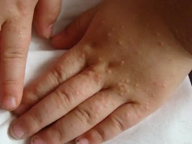 【求助】儿童双手湿疹?