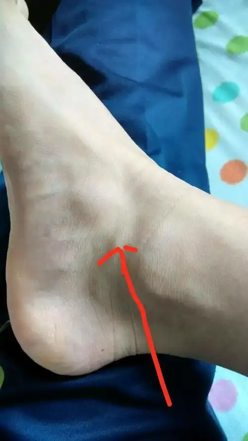 在如图所示的位置会有一些疼痛在进行脚部旋转时会听见响声然后抬脚尖