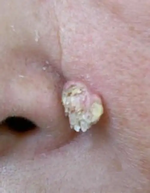 扁平疣图片_扁平疣症状表现图片大全_有来医生