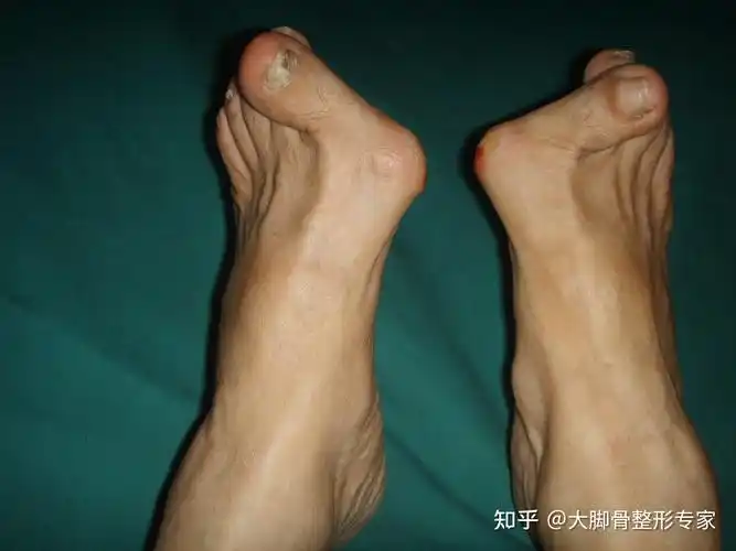 那些不做手术的拇外翻会发展到怎么样