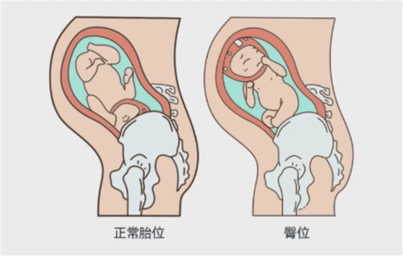 郑医生提醒,宝宝胎位不正,孕妇及家人千万不能自行进行胎位转正.