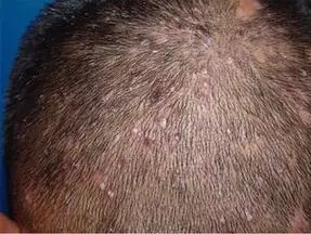 毛囊炎图片_毛囊炎症状_深圳新兴皮肤病专科