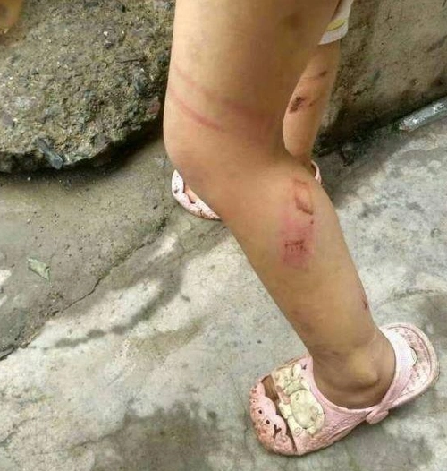 图片中很明显看到孩子的脚受伤了.