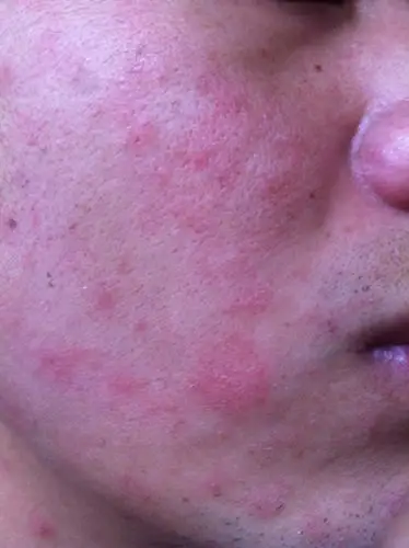 脸上长癣图片 (14)_有来医生