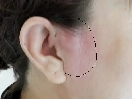 耳前淋巴结肿大