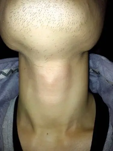 喉结下面突出感觉跟又张了个喉结一样又粗又硬.喉咙里面有点疼痛