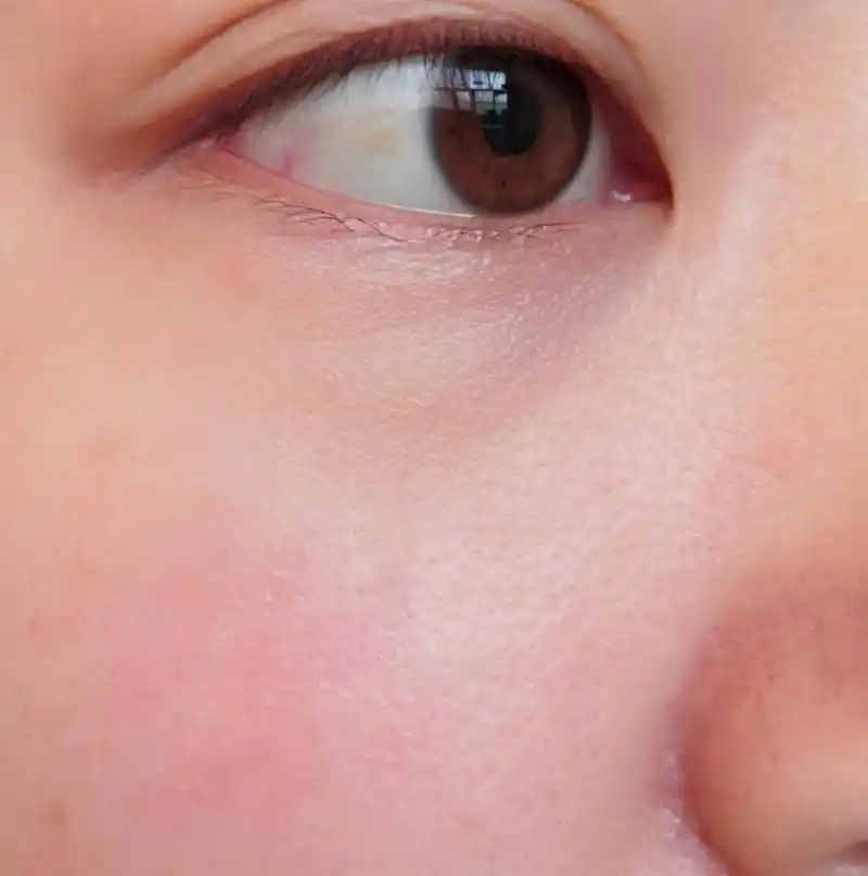 眼部红血丝,眼袋黑眼圈,毛周角,脸上时不时会泛红,对头发过敏,黑头