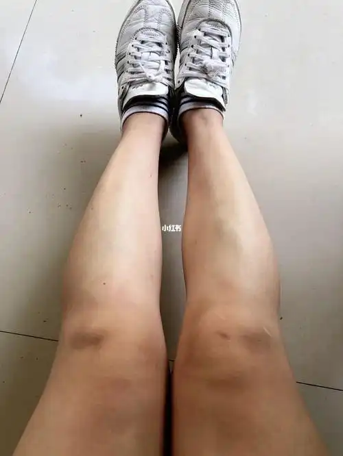 帮我看看膝盖突起的两个小包是仲么回事.因为最近在跳减脂躁