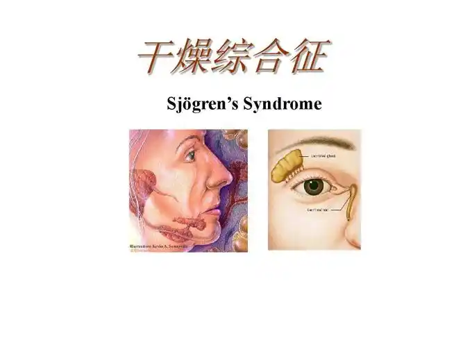 干燥综合征ppt