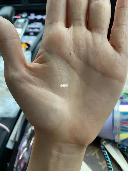 左手手心后天痣