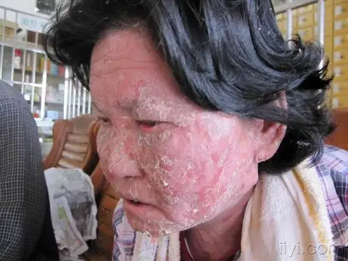 吓人的皮肤病---已用了几十万医药费!