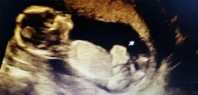 孕16周时b超发现胎儿腹裂,羊穿结果显示正常,医生却说不容乐观