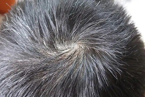 青少年为什么会有白发少年白是怎么回事多图