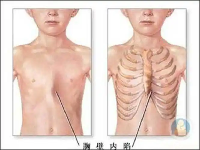 大人佝偻病图片_有来医生