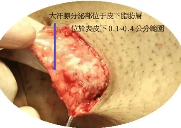 随着手术方式的改良,从传统的"全切",到"z"型切口,再到小切口微创