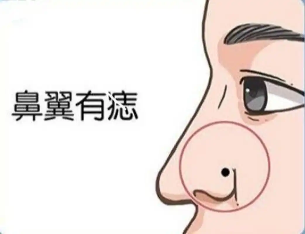 鼻翼上长痣代表什么 1,鼻翼有痣(鼻子两侧):鼻之两翼有灰黑之痣的话
