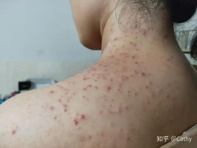 马拉色菌毛囊炎怎么治?