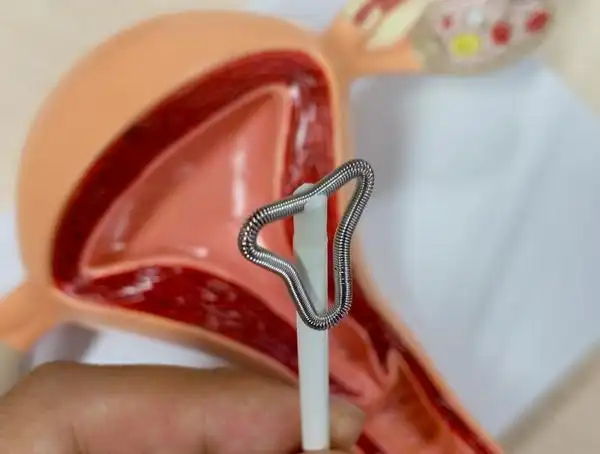 科普|避孕环,节育环,宫内节育器,到底是个啥?