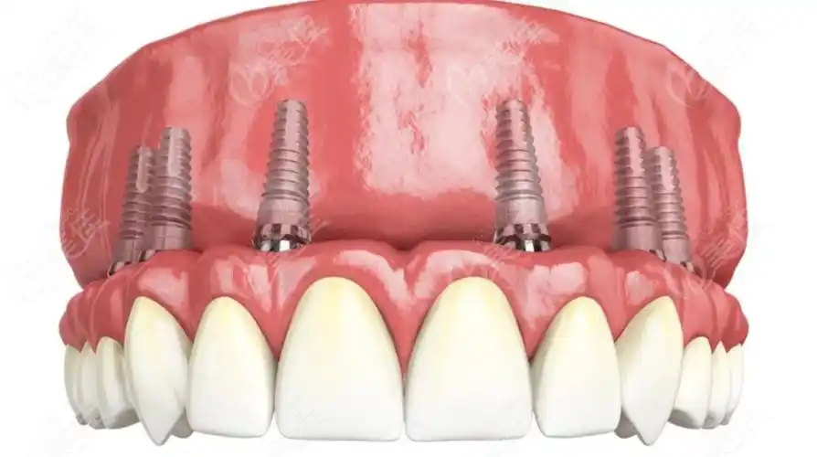 半口种植牙卡通图