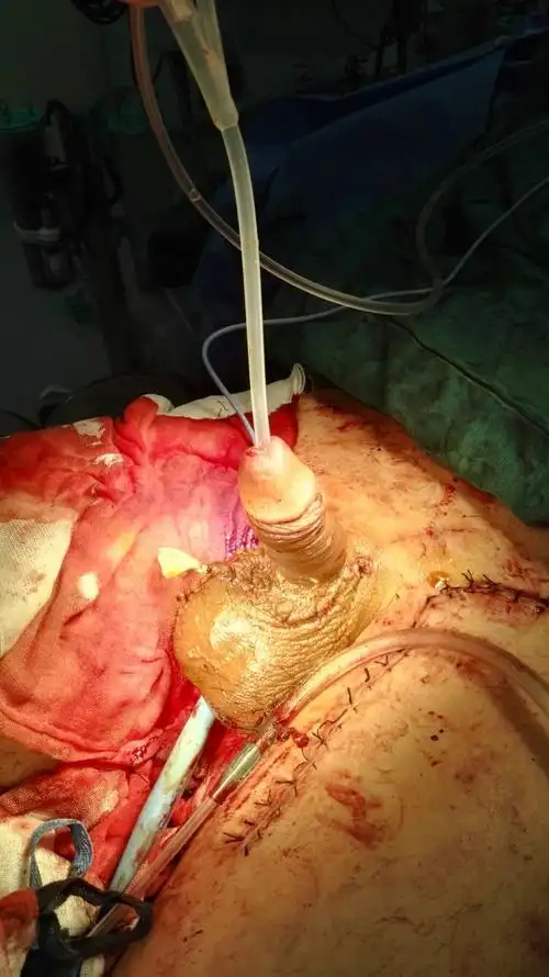 济宁医附院再修一,如此外伤,阴茎可能保得?