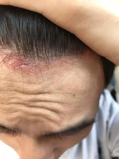 头皮问题 瘙痒掉屑