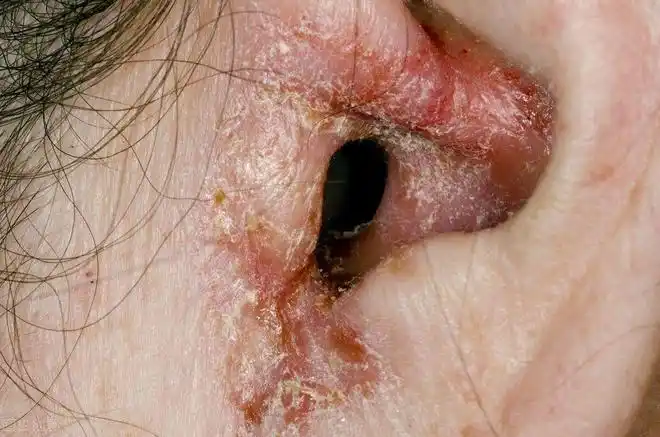 生活中这4种常见疾病出现,或会使我们的耳朵瘙痒难耐,要注意