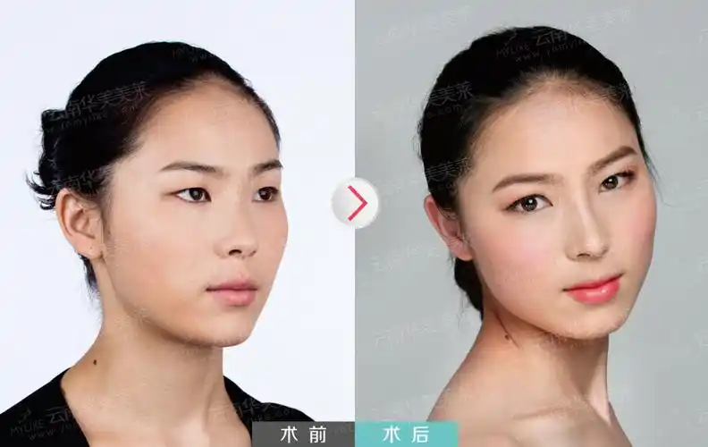 单眼皮怎样变双眼皮?_云南华美美莱整形美容医院