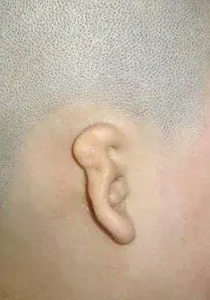 需要进行耳再造手术,耳甲腔型的患儿根据情况选择不同类型的耳朵手术