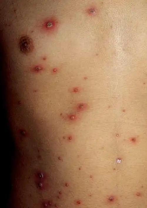 水痘的概述和预防