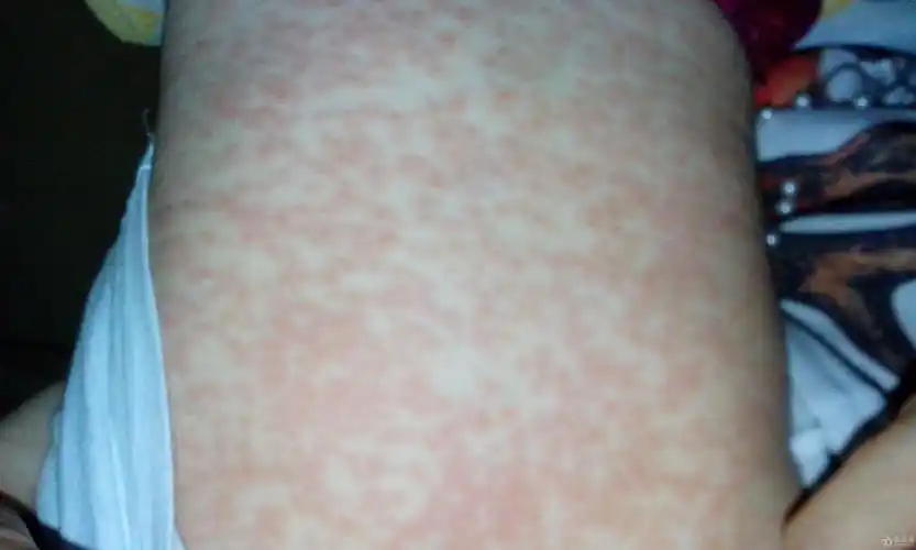 反复发热8天,皮疹3天,考虑麻疹