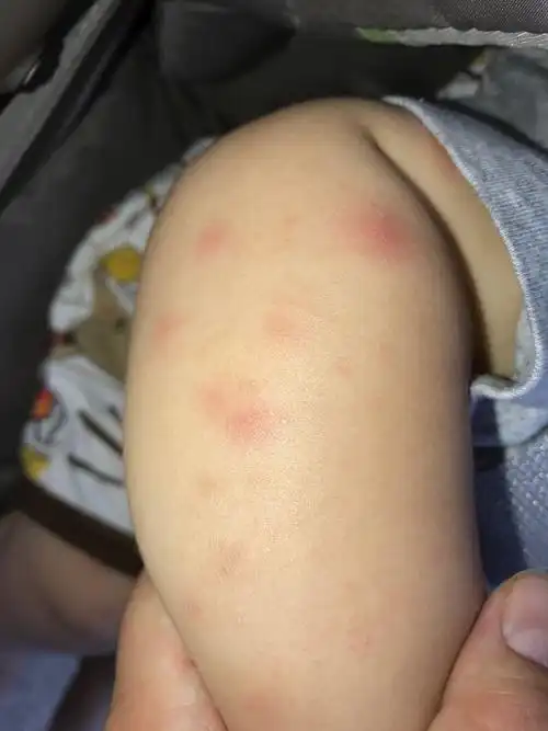 宝宝八个月了最近手脚上总是有很多红色的大疙瘩小疙瘩大疙瘩