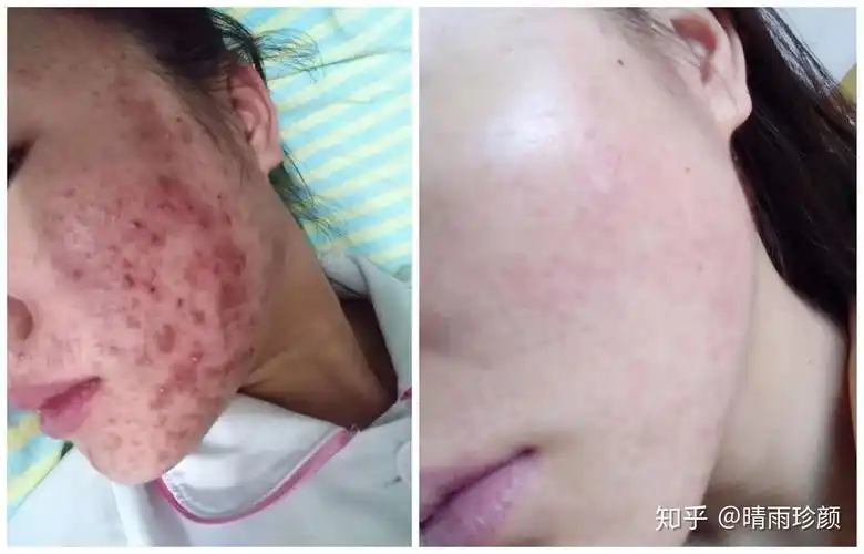 痘痘肌,敏感肌用什么护肤品好?