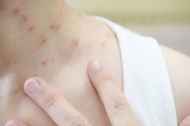 艾滋"携带者"约125万!若脖子出现这迹象, 是否需要做血测?_疾病