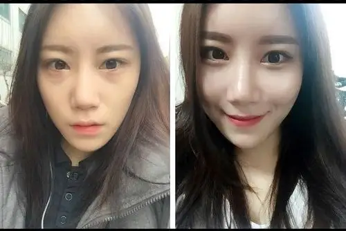 自体脂肪填充苹果肌效果图分享,肌肤q弹的秘诀~_整形案例_美丽无忧网