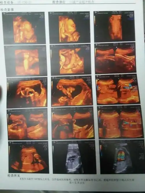 宝妈们看看这四维像男宝还是女宝