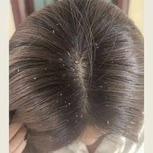 头皮屑_成分_问题