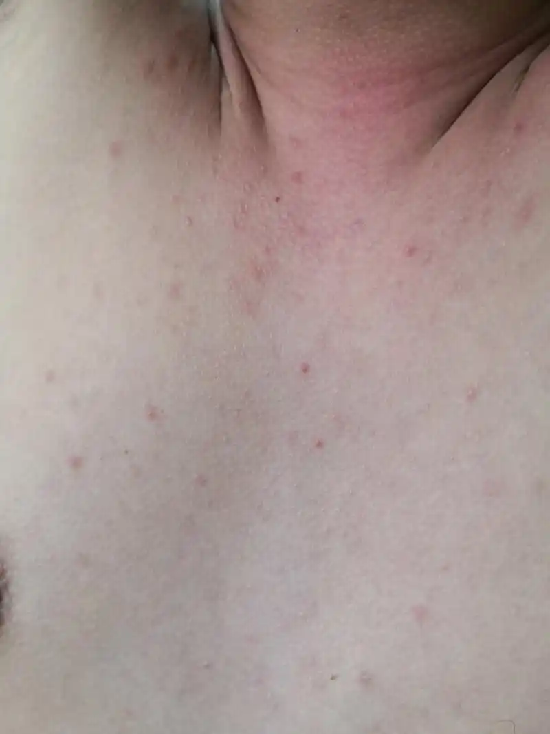 考虑马拉色菌毛囊炎症状#解决皮肤问题专注皮肤美容##马拉色菌毛囊炎