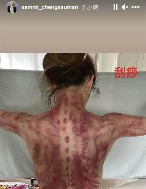 突破尺度!郑秀文晒背部全裸照 刮痧后鲜红一片