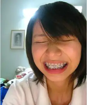 太美了3位西安妈妈203040岁矫正龅牙小虎牙后美成这样