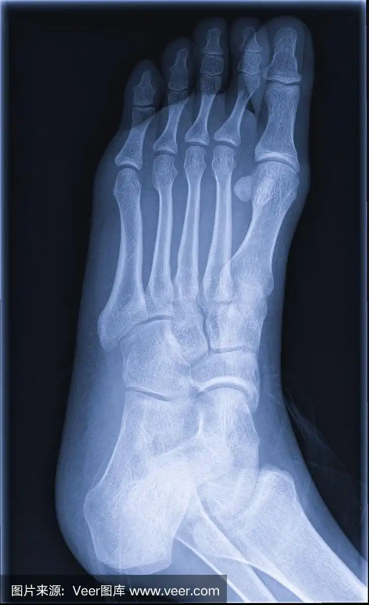 脚x射线