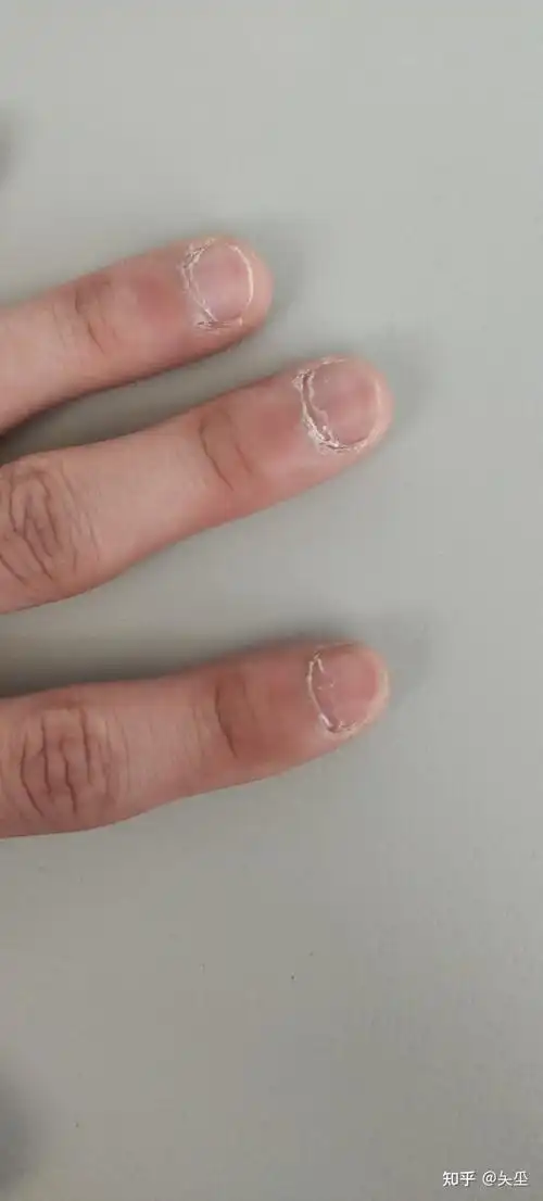 指甲根部手指肉的部分发白而且还有倒刺还有皮皮怎么回事