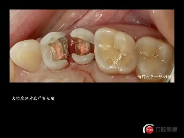 两颗双尖牙的死与生