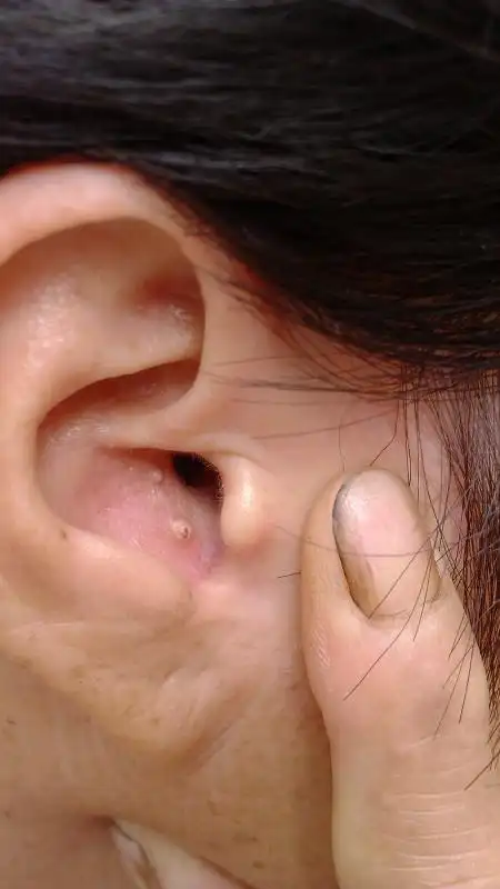 请问下我妈妈耳朵边上长了白色的包,还痒,谁知道啊?