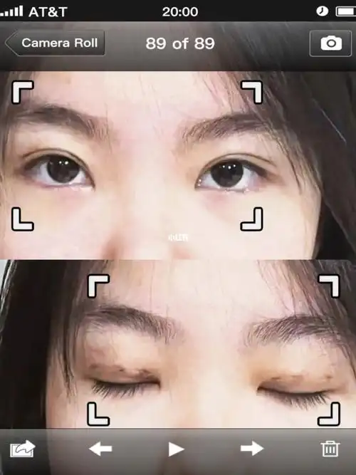 三点双眼皮  #双眼皮恢复