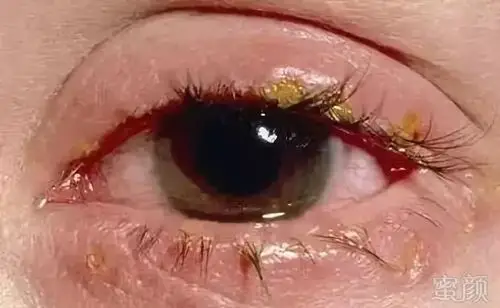 发痒和疼痛的感觉,有的人甚至眼睑周围会产生溃疡,睫毛掉落的现象