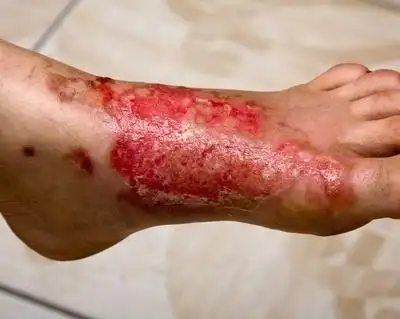 艾滋病患者腿脚部图片