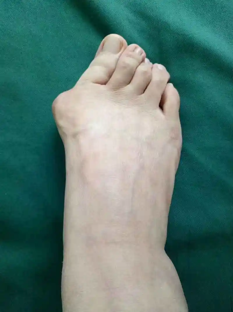 高跟鞋与拇外翻疾病真的有直接关系吗?